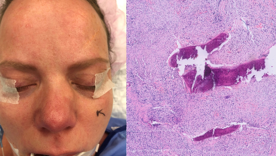 Foto 1: Patiënte met links naast de neus een zwelling. Foto 3: HE-kleuring; microscopische vergroting (5x). 