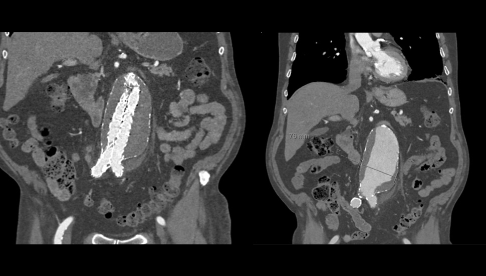 Foto 2 (links): Status na ongecompliceerde EVAR (endovasculaire aneurysma repair). Foto 3 (rechts): Aneurysma van de abdominale aorta, maximale diameter 76 mm in het coronale vlak. De bolle wand met verkalkingen aan de linkerzijde van het aneurysma was ook te zien op de initiële buikoverzichtsfoto, geduid als aanwijzingen voor de aanwezigheid van een fors aneurysma van de abdominale aorta.   Status na ongecompliceerde EVAR (endovasculaire aneurysma repair).