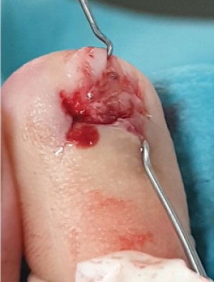 Digitus II van de rechtervoet, na verwijdering van de nagel en opening van het nagelbed is een tumor te zien van ongeveer 8 mm groot.
