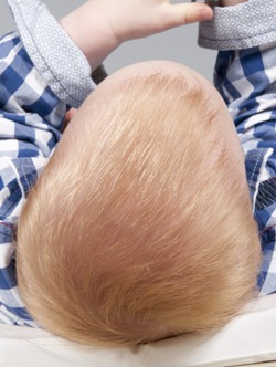 Op de leeftijd van 14 maanden zijn de contouren van de cefale hematomen nog steeds zichtbaar, rechts meer dan links.