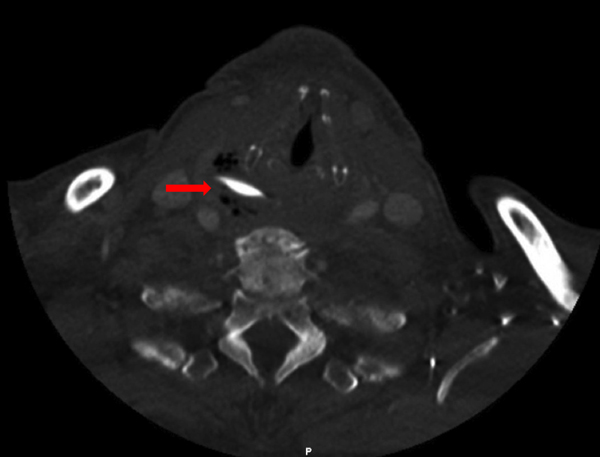 De CT-scan toont een corpus alienum in de retrofaryngeale ruimte. 
