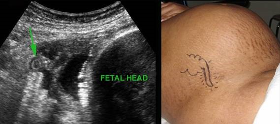 Figuur 1. Door de vergrote, gravide uterus wordt de ontstoken appendix  (pijl) tegen de buikwand gedrukt en is deze  gemakkelijk af te beelden. Een op de huid getekende appendix (rechts) stelt de chirurg in staat minimaal invasief te opereren. 