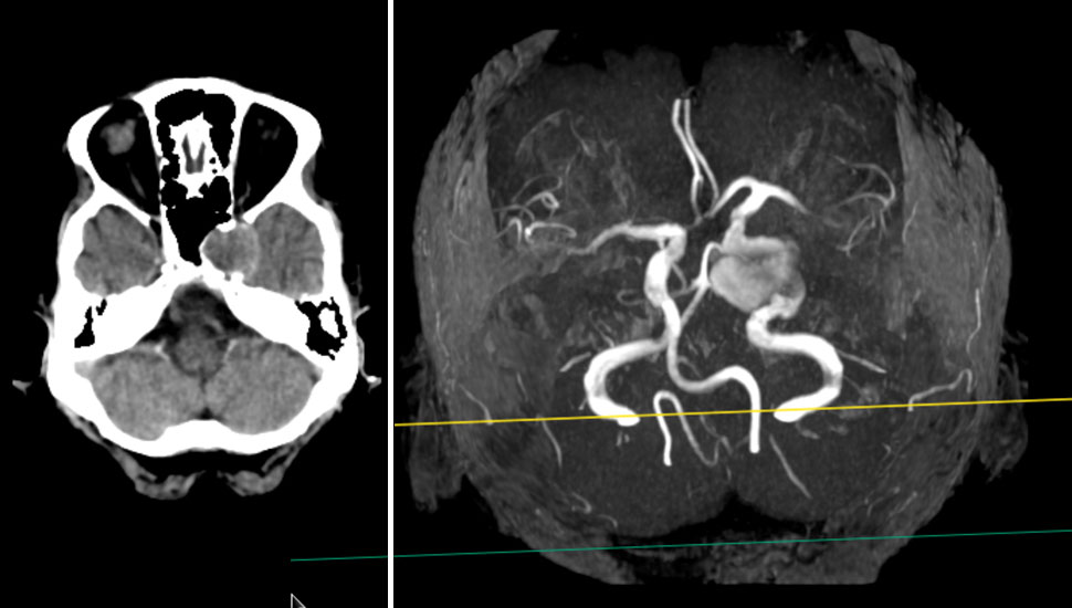 1. CT van cerebrum met ronde gedeeltelijke iso-intense afwijking links in de sinus cavernosus. | 2. MRA met aneurysma vanuit de arteria carotis interna links.