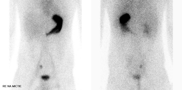 Figuur 1:Technetium-99-scan waarop een hotspot is te zien rechts onder in de buik, suggestief voor een lokalisatie van ectopisch maagslijmvlies zoals dat in een meckeldivertikel kan voorkomen.