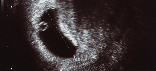 Een overtijdbehandeling kan tot 17 dagen zwangerschap (6 weken + 2 dagen na de laatste menstruatie) worden uitgevoerd.<BR>beeld: Getty Images