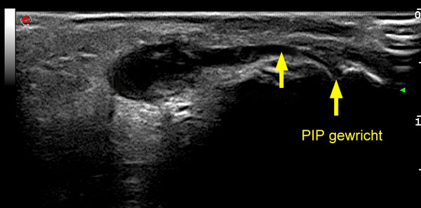 Een echo van de middelvinger toont een cyste (ganglion), die van het PIP-gewricht uitgaat.