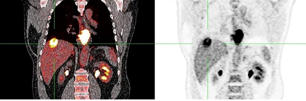 2. Coronale PET-CT opname bij patiënt B. Pathologische FDG-stapeling in de leverhaard in segment 8 (groene markering).