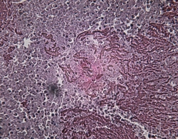 Microscopisch beeld van een tuberculose geïnfecteerde long. Beeld: Thinkstock