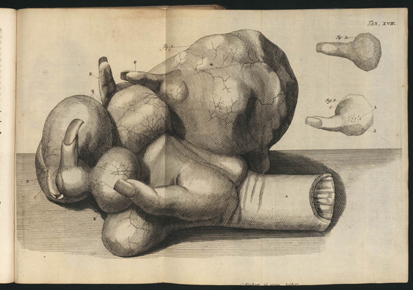 Gezwellen op een hand – geprepareerd door de bekende chirurgijn Frederick Ruysch. Ruysch verzamelde afwijkingen in een kabinet dat tegen betaling kon worden bezichtigd. (1697)