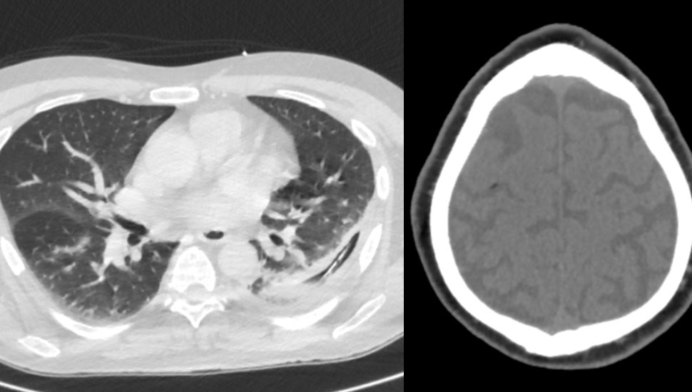 beeld auteurs. 1. De drain zichtbaar links dorsaal in de pleuraholte. 2. Lucht zichtbaar in stroomgebied rechter arteria cerebri media.   