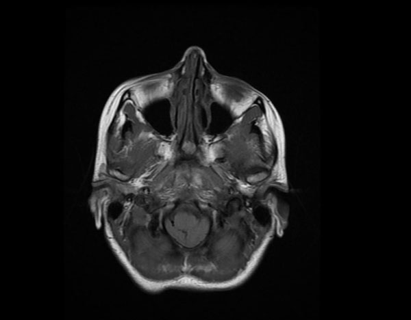 MRI-cerebrum, axiale T1-opname: medulla oblongata en cerebellaire tonsillen in het foramen magnum.