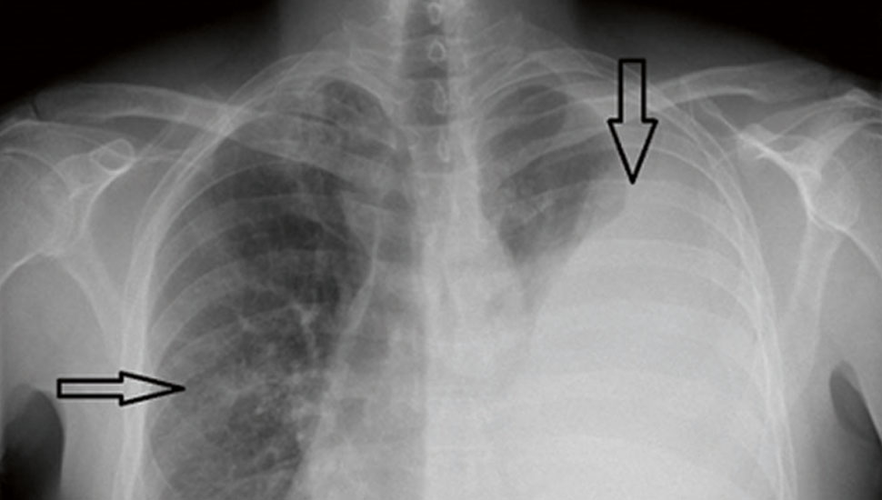 beeld auteurs. X-thorax: uitgebreide hoeveelheid pleuravocht links met versterkte longtekening rechts apicaal.