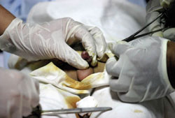 Niet-therapeutische circumcisie bij minderjarige jongens is in strijd met de regel dat minderjarigen alleen mogen worden blootgesteld aan medische handelingen als er sprake is van ziekte of afwijkingen. beeld: Reporters/Fresh Images 