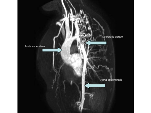 MRI van het hart toont een coarctatio van de aorta descendens met een pinpointstenose. Ook is uitgebreide collateraalvorming te zien