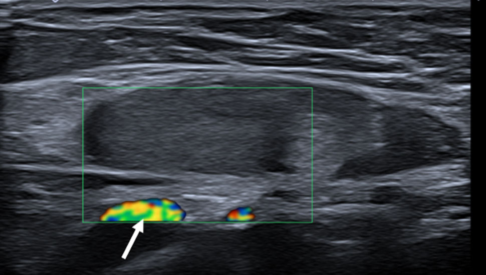 Duplexechografieopname van de inguinaal gelegen rechtertestis. Hierop is zichtbaar dat een testiculaire vascularisatie ontbreekt. In deze opname markeert de pijl flow in de liesvaten.