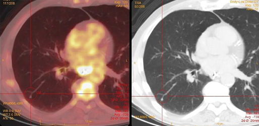 3. Transversale PET-CT-opname bij patient C. Matig pathologische FDG-stapeling in nodulaire laesie in de rechterlong (rode markering).