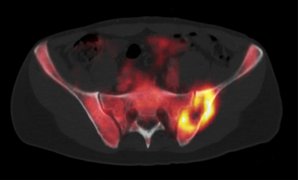 De PET-positieve laesie in het os ilium links. De centrale necrose is duidelijk zichtbaar. 