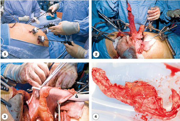Een slokdarmkankeroperatie bestaat uit twee delen. Eerst wordt het onderste tumordeel laparoscopisch geopereerd (1), vervolgens wordt het aangedane deel van de oesofagus verwijderd (2) en tot slot worden maag en het hogere deel van de oesofagus met elkaar verbonden (3). Het verwijderde weefsel (4). Beeld: ANP Photo
