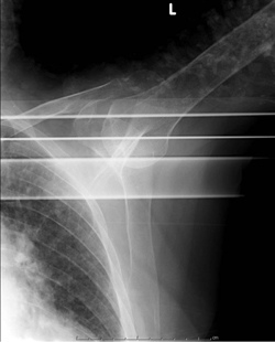 Op de röntgenfoto lijkt de humeruskop in het glenoïd te liggen.