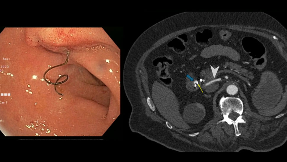 L: Wiggling coil. Coil zichtbaar tijdens gastroscopie op de overgang van het duodenum pars superior (bulbus) naar het descenderende duodenum (pars II). R: Contrast extravasatie (blauwe blokpijl) en coil (gele smalle pijl) zichtbaar ter plaatse van de arteria gastroduodenalis (witte pijlkop) op CT-angiografie.