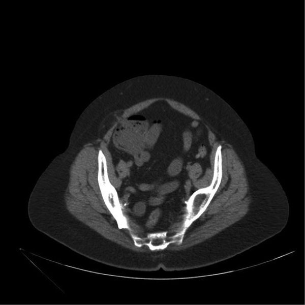 De CT-scan toont een hernia Spigelii met als inhoud de appendix vermiformis.