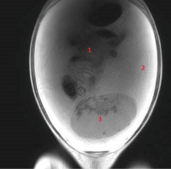Te zien op MRI-coupe van de buik: darmpakket (1), de ascites (2) en de tumor (3).