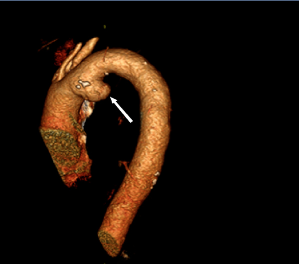 CT-scan van het sacculaire aneurysma in de aortaboog.
