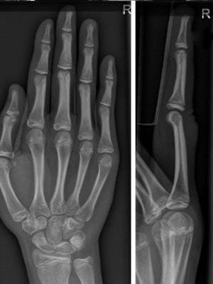 Foto 2: Röntgenfoto van de rechterhand en een detailopname van digitus III rechterhand tonen een normale botstructuur en kalkgehalte. Alle gewrichten zijn normaal en er is geen sprake van kraakbeenverlies, erosies of osteofyten. Kortom, geen aanwijzingen voor erosieve artritis of artrose.   