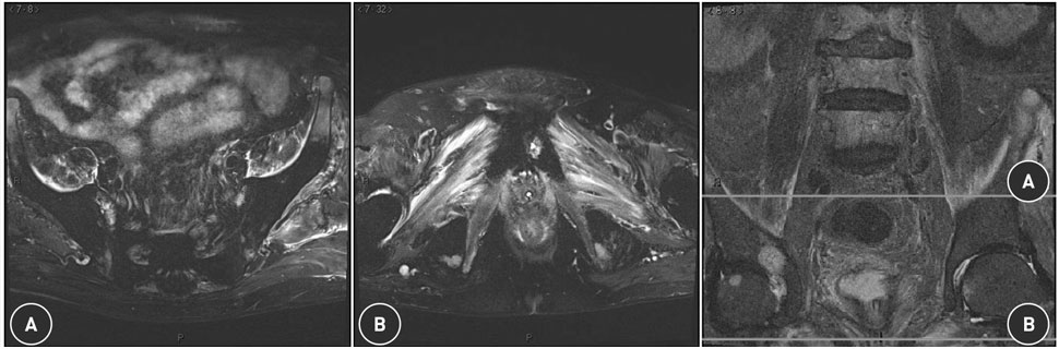 MRI T2-gewogen opnames van het bekken (A, B) en de lumbale wervelkolom met proximale doorsnede (A) en distale doorsnede (B). A: intramusculair oedeem in de linker gluteaalmusculatuur en symmetrisch in de m. iliacus. B: symmetrisch intramusculair oedeem in de spieren van de bekkenbodem.