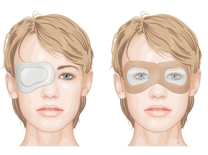 Het afplakken van de ogen na een staaroperatie middels delayed sequential bilateral cataract surgery (huidige standaardprocedure (in twee stappen); links) versus immediate sequential bilateral cataract surgery (nieuwe methode; rechts).