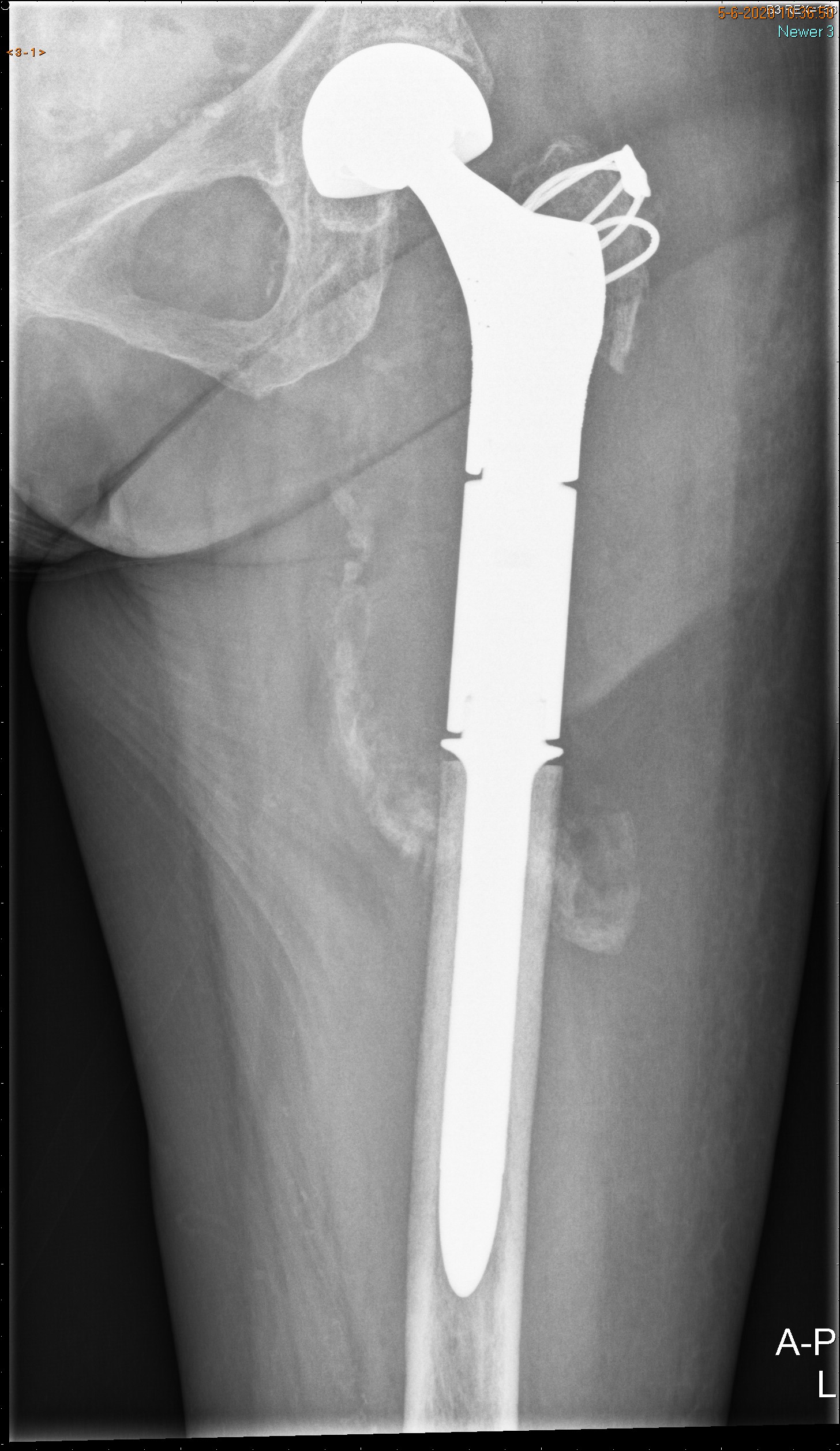 Röntgenfoto met prothese, van na de operatie