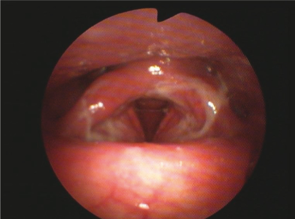 Bij laryngoscopie waren grijzige membranen op en rondom de stembanden en tongbasis te zien en de larynx was gezwollen. Bron: Eurosurveillance.