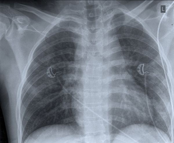Op de X-thorax wordt na snelle beoordeling een longcontusie links gezien, maar het verbreedde mediastinum wordt gemist.