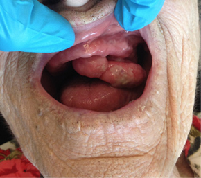 Figuur b. Gesteelde tumor in de mondholte, foto genomen op de dag van poliklinische excisie