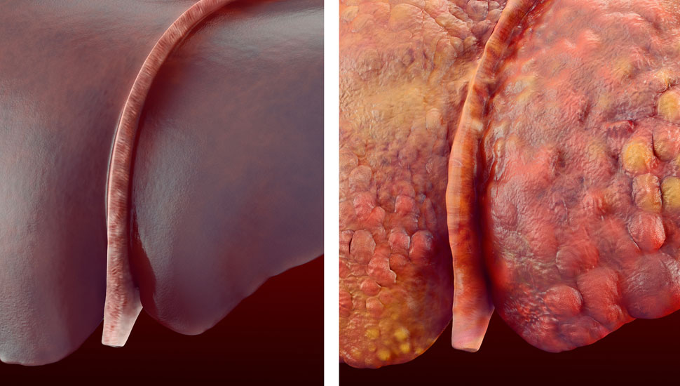 Links: gezonde lever, rechts: levercirrose - Getty Images