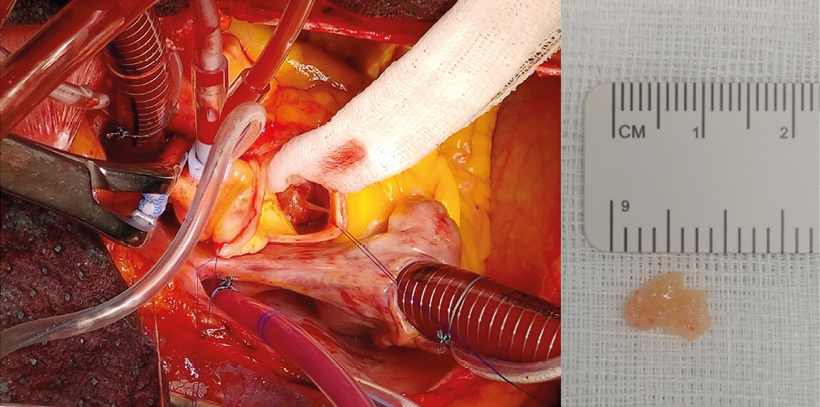 2. Uitzicht op de afwijking intraoperatief na aortotomie (links) en na excisie (rechts).   