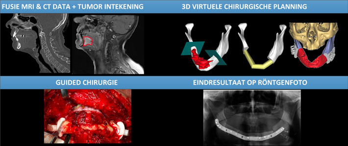 Figuur 1: Schematische weergave van de 3D VCP-werkwijze bij een patiënt met een tumor in de mondholte. De CT- en MRI-data worden gefuseerd, gevolgd door het maken van een 3D-model van zowel het bot als de tumor. Na het vastleggen van de resectievlakken en daaropvolgend de reconstructie van het ontstane defect wordt de patiënt geopereerd met behulp van 3D-geprinte zaagguides/templates. De laatste afbeelding toont een 2D-röntgenopname (orthopanthomogram) van het eindresultaat.