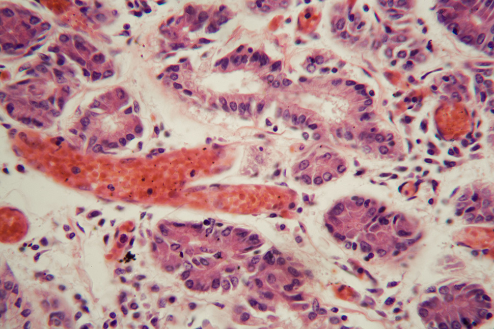 Menselijke longweefsel met longembolie onder een microscoop. Getty images