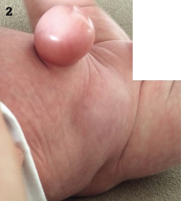 Aanzicht van rechtsboven van de zwelling in het rechteronderkwadrant van de buik en de hernia umbilicalis.