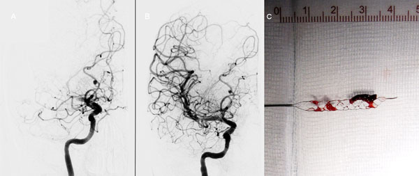 Angiografie-opnamen voor (A) en na (B) mechanische trombectomie met een verwijderbare stent bij een patiënt met een acuut hemibeeld links ten gevolge van een acute proximale occlusie van de arteria cerebri media rechts. (C) toont de trombus in de stent.<br>Beeld: Charles Majoie