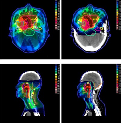 Links de verdeling van de stralingsdosis bij conventionele (fotonen)radiotherapie, rechts bij protonentherapie.