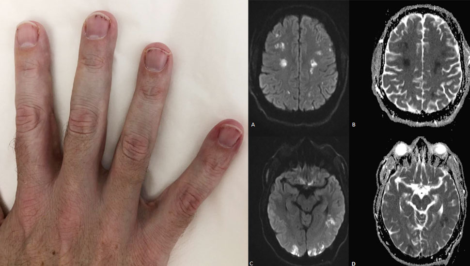 1. Splinterbloedingen onder de nagels. 2. Meerdere herseninfarcten op diffusiegewogen MRI-beelden (DWI).