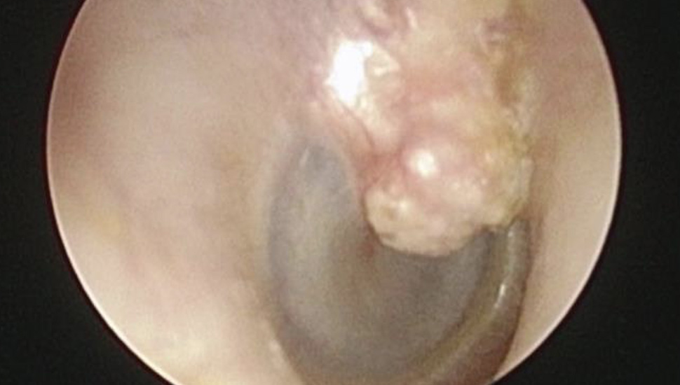 1. Op de micro-otoscopie is een intact trommelvlies, een luchthoudend ­middenoor en een osteoom uitgaande van de malleus te zien.