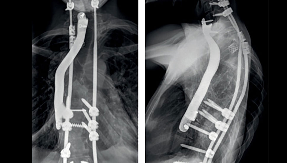 Röntgenfoto van de wervelkolom na plaatsing van het implantaat - The Lancet