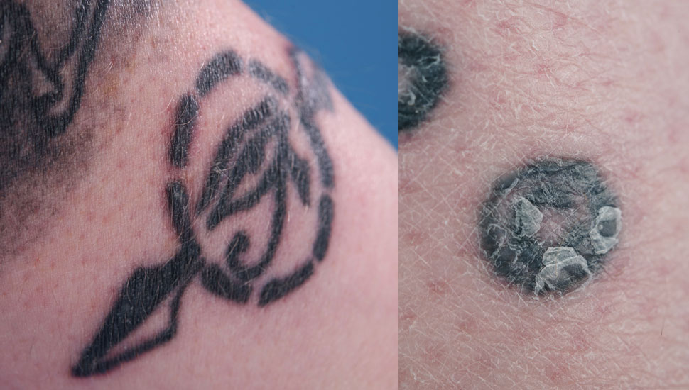 Papulonodulaire reactie in een tatoeage op de arm.