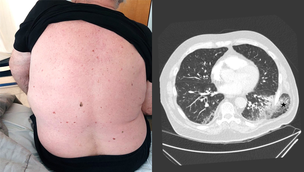Foto 1 (links): Foto van de rug van patiënt genomen tijdens inspiratie. Foto 2 (rechts): Axiale doorsnede (longsetting). Herniatie van de linkeronderkwab. Het parenchym van de linker­onderkwab toont hierbinnen enige consolidatie en matglas (zie ster).