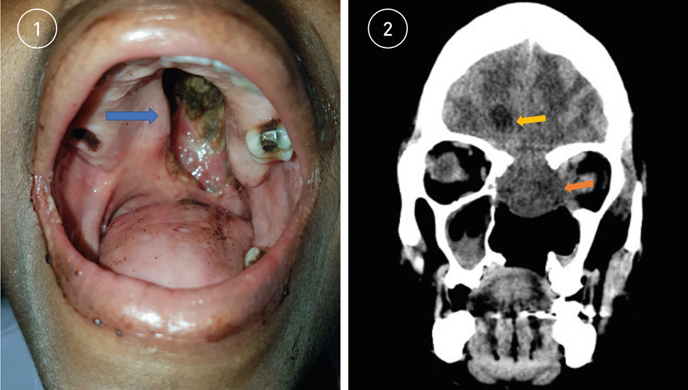 Beeld auteurs | 1 (links): Palatum-defect (blauwe pijl) met achterliggend weefsel van onduidelijke origine. | 2 (rechts): CT-scan zonder contrast van het hoofd met hypodensiteit rechts frontaal (gele pijl) en destructie van palatum, sfenoïd en orbita links met herniatie van hersenweefsel (oranje pijl).