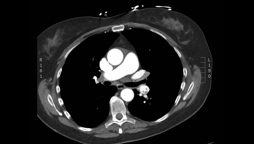 Transversale CT-coupe toont meerlobbig stolsel in de arteria pulmonalis sinistra.   