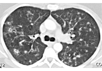Figuur 1. CT van de thorax met uitgebreide cysteuze en interstitiële afwijkingen