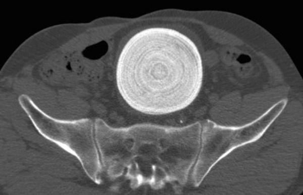 De CT-scan toont een hyperdense, solide, bolronde massa van 9,4 cm doorsnede in de Studer-pouch.